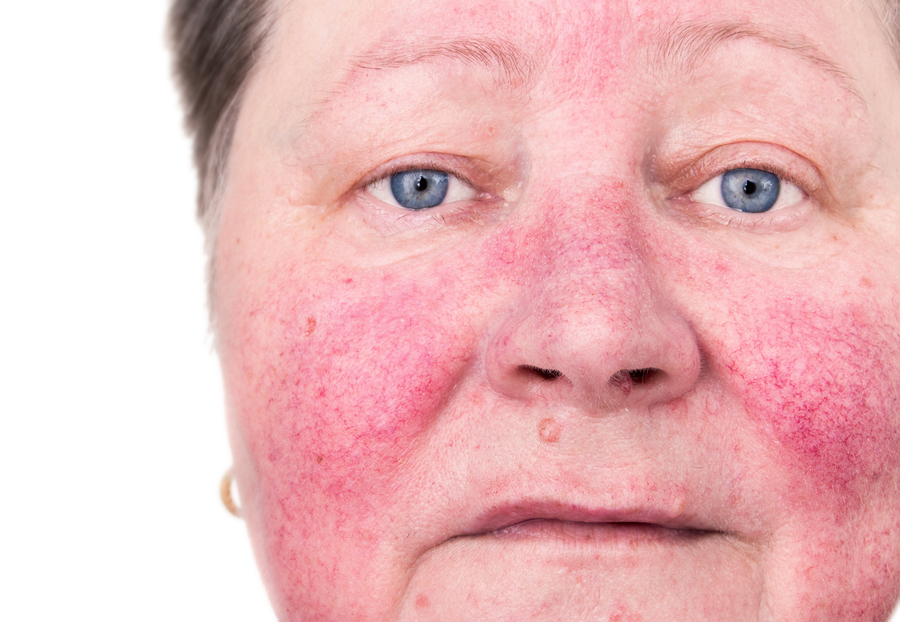 Home Care in Palo Alto CA: Rosacea Awareness Month