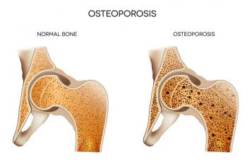 Elder Care Aptos, CA: Osteoporosis Risk Factors