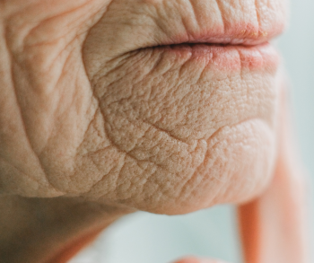 Caring for Dry Senior Skin